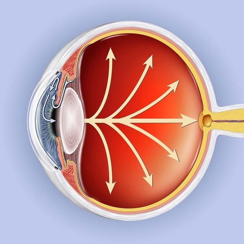 Esta es la importancia de prevenir el Glaucoma.